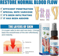Varicose Veins Treatment